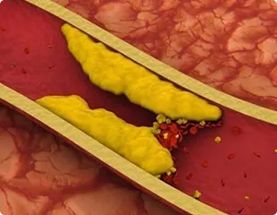 Placas de colesterol nos vasos